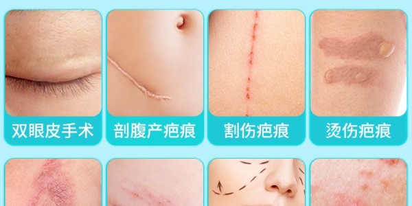 疤痕貼與疤痕凝膠的使用指南及效果分析